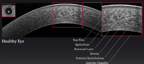 oct measurement for corneal thickness|oct for anterior segment.